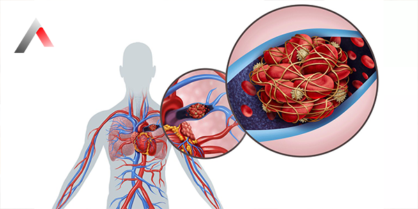 Pulmoner_Emboli_Nedir_30b5f7e8.webp