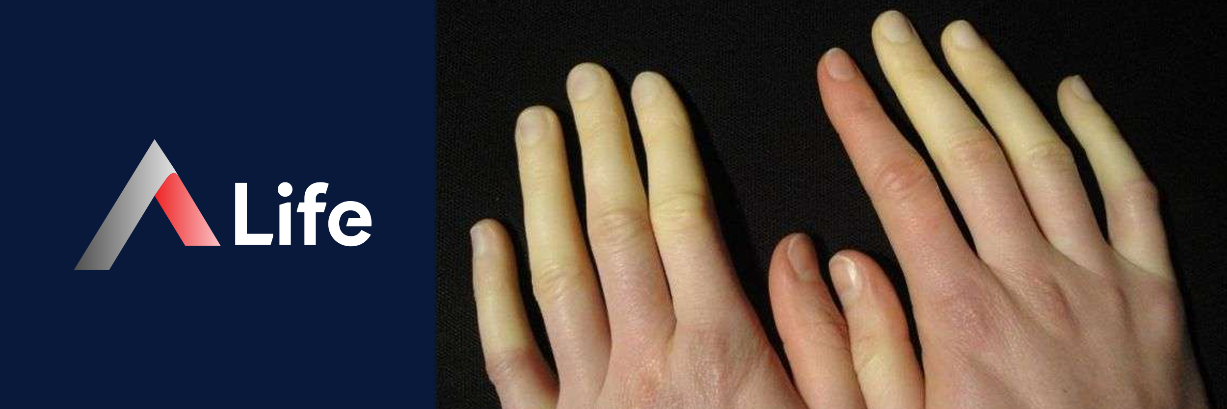 Raynaud_Hastal_______Hakk__nda_S__k_Sorulan_Sorular_734ac716.webp