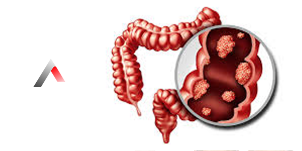Rektum_Kanseri_Belirtileri_7487bf24.webp