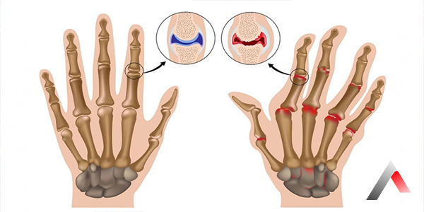 Romatoid_Artrit_Nedir_4d3acd25.webp