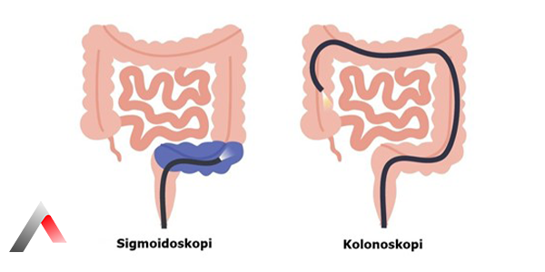 Sigmoidoskopi_648a36c4.webp