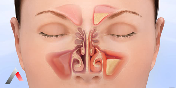 Sin__zit_Nedir_4ebe3333.webp