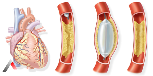 Stent_Takma_____lemi_f94c8f3a.webp