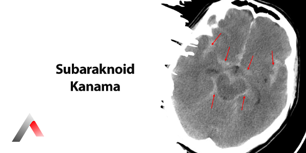 Subaraknoid_Kanama_aa3e14b2.webp
