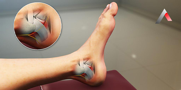 Tarsal_T__nel_Sendromu_42dd59e7.webp