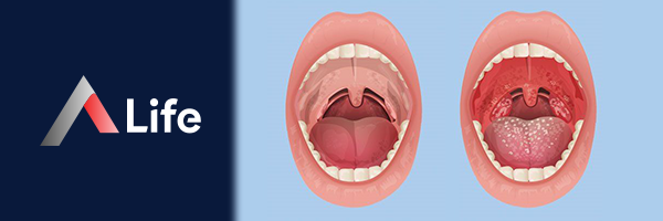 Tonsilit_Nedir_4b289992.webp