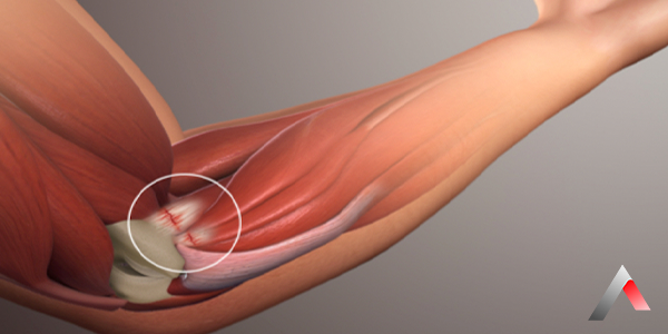 Ulnar_Sinir_S__k____mas___7c5804c8.webp