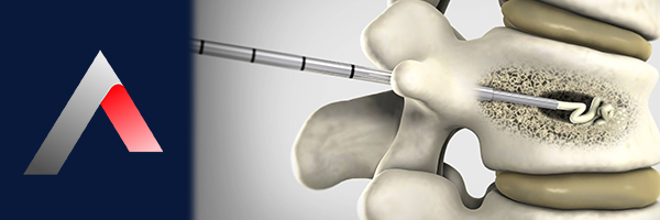 Vertebroplasti_10c458b4.webp