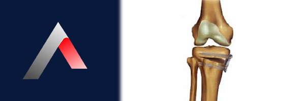 Y__ksek_Tibial_Osteotomi_56ee15d4.webp