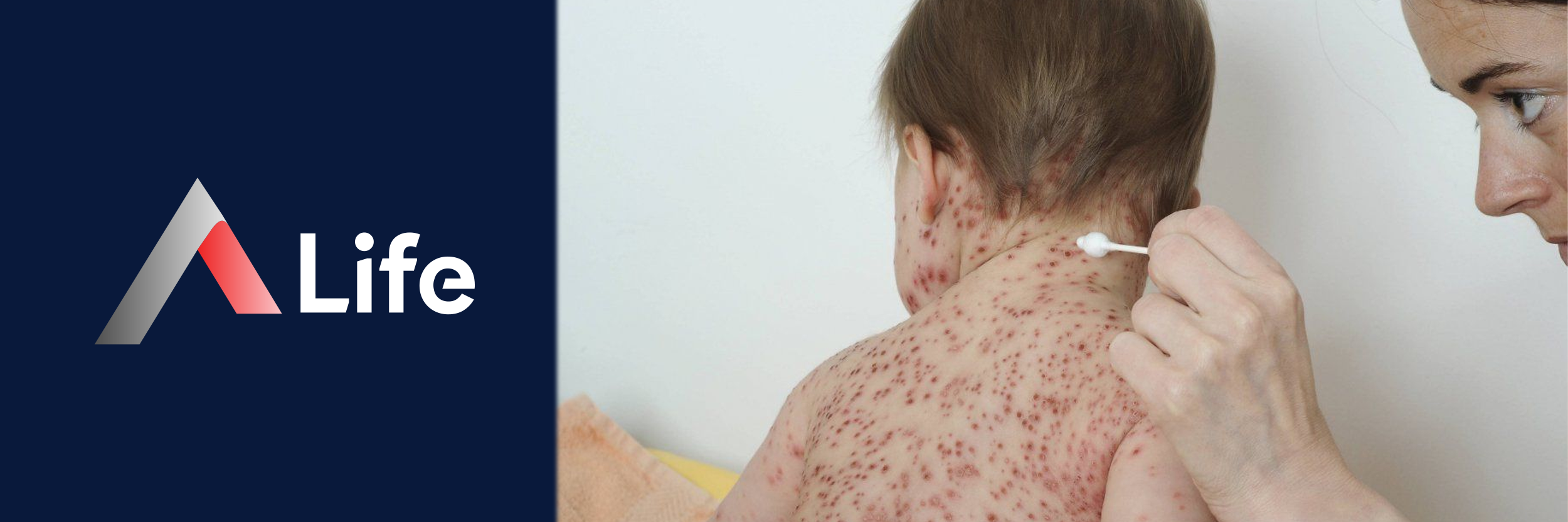 __i__ek_Hastal________Variola_Virus____Nedir_203c3070.webp