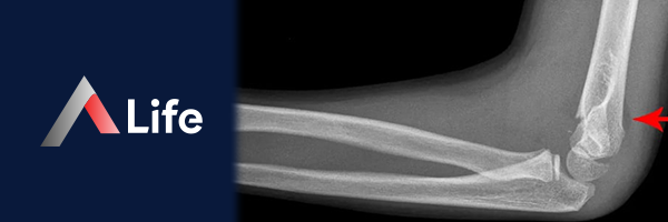 humerus_alt_u___k__r__________ac8d66c4.webp