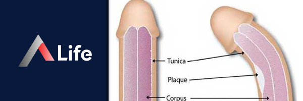 penil-plikasyon.jpg_31e02b2a.webp