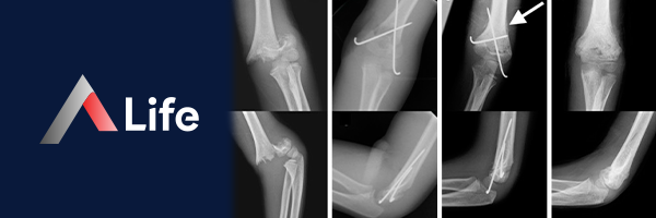 suprakondiler_humerus_k__r__________634d60bd.webp
