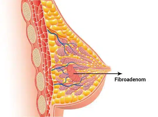 fibroadenom kansere donusur mu 1 1